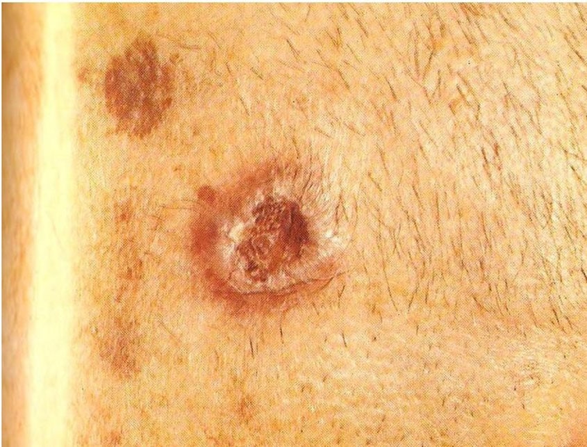 Βασικοκυτταρικός – Ακανθοκυτταρικός Καρκίνος Δέρματος